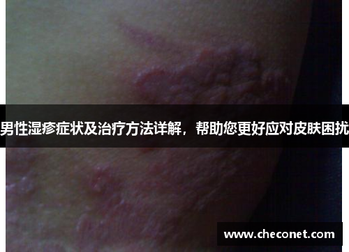男性湿疹症状及治疗方法详解,帮助您更好应对皮肤困扰 男性湿疹症状及治疗方法详解,帮助您更好应对皮肤困扰